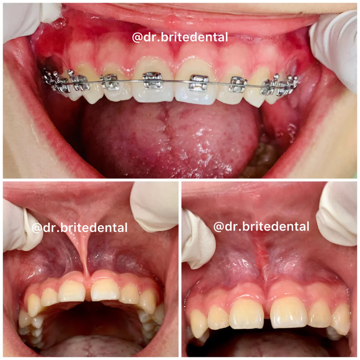 Braces and frenectomy treatment showing gap closure for a child at Brite Kids Dental in Gardena