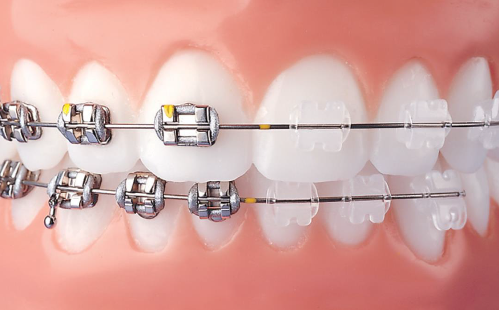 Metal and clear braces ptions for kids and teens at Brite Kids Dental in Gardena